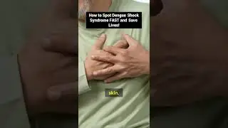 Unlock the Secrets to Identifying Dengue Shock Syndrome Instantly!