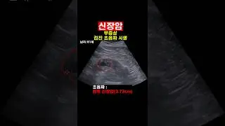 신장암 초음파 진단