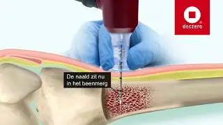 Botnaald inbrengen | Doczero E-learning