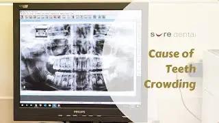 What Causes Teeth Crowding