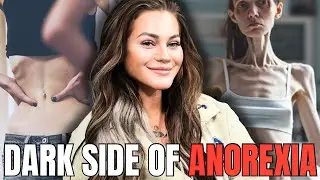 The Secret Hell of Anorexia: My Road to Recovery, Relapse Triggers & What It's Like to Live With It