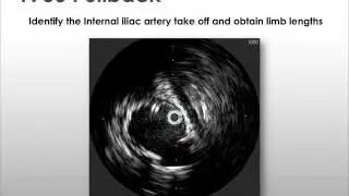 Dr. Tuchek - EVAR with IVUS Case Study #2