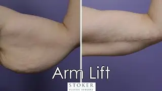 Arm Lift Los Angeles: Top Plastic Surgeon Dr. Stoker Reveals Extreme Makeover After Weight Loss