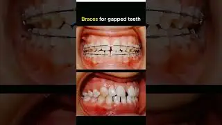 BRACES FOR GAPPED TEETH 😁 #dentalprosthesis #orthodontist #dentist #shortsfeed