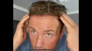 HAIR TRANSPLANT 6 MONTH UPDATE