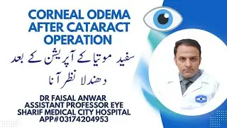 &ldquo;Corneal Edema After Cataract Surgery: Causes, Management