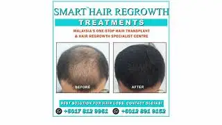 Transform Your Look with SMART&trade; FUE - Before & After | Glojas Aesthetic Clinic