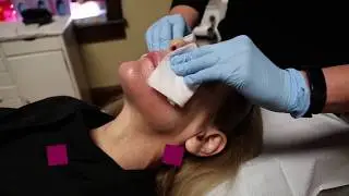 Cool Peel Success-Aesthetica Cosmetic & Laser Center-Bethlehem, PA