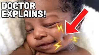 How DIMPLES Form! | DOCTOR Explains in 90 Seconds