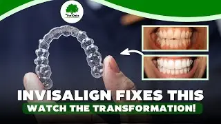 Orthodontic Problems fixed with Invisalign 😁✨