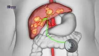 HAI Therapy - How the Therapy and Intera 3000 Pump Works?