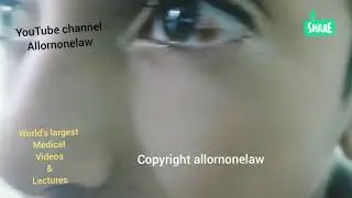 Congenital mole inside the eye