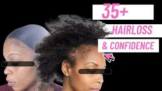 “Dealing With Traction Alopecia at 35+ | Real Life, Hair & Confidence”