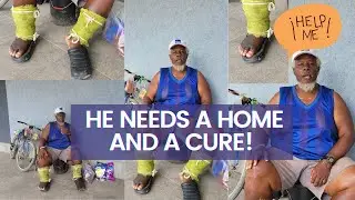 Man With Rotten Feet Needs Help  with proper living conditions and cure for his feet.