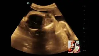 Apert syndrome fetal ultrasound by Dr.Haissam Aref, DMS, MSc, MD ultrasound