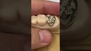 Patient choose Gold crown instead of zirconia @EnvisiontecMain #envisiontec