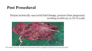 Fetoscopic Laser Photocoagulation for Stage II TTTS &ndash; Video abstract [566266]