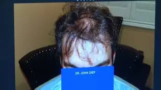 Before & After Hair Transplant Surgery by Dr. Diep | MHTA CLINIC