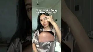 Forehead acne or Closed comedones‼️ #dandruff #closedcomedones #cloggedpores #foreheadacne #acne