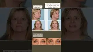 Tired Eyes Treatment - Dr. Catherine Weng - Aesthetic Facial Plastic Surgery Center - Wayne, PA