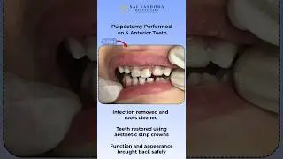 Pediatric Dental Care: Pulpotomy on 4 Anterior Teeth | Amazing Smile Restoration