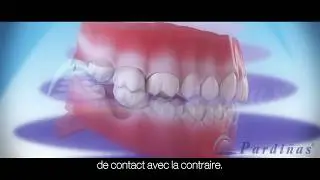 Cons&eacute;quences de ne pas remplacer une dent manquante &copy;