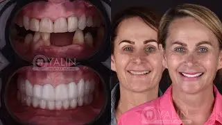 ALL ON FOUR IMPLANTS & ZIRCONIUM CROWNS | DENTAL IMPLANT TURKEY PRICES