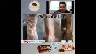 Pie diabetico tratado con los productos Gano Excel.