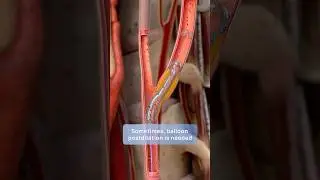 How carotid stenting prevents stroke: a step-by-step 3D guide to restoring blood flow