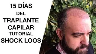 Trasplante Capilar Recomendaciones a los 15 días [5 Tutorial]