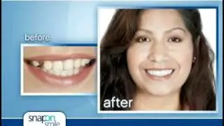 Snap-On Smile