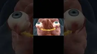 Vision Loss from Optic Nerve Blood Flow Problem