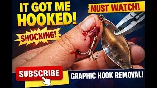 Safe and Easy Guide to Removing a Hook from Your Hand