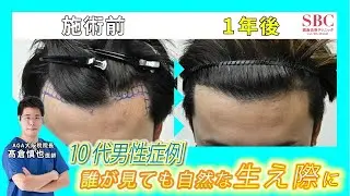 【植毛症例】10代男性症例 誰が見ても自然な生え際に