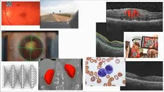 Airways Segmentation with Deep Learning by RSIP Vision