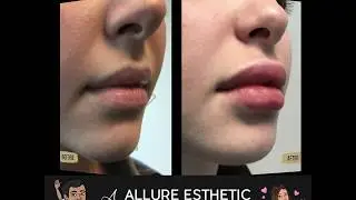 Restylane-L Lip Filler Injections in Seattle | Before and After Progression