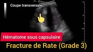 Fracture de Rate H&eacute;matome sous capsulaire Grade 3 AAST &Eacute;chographie Splenic injury Scale Ultrasound