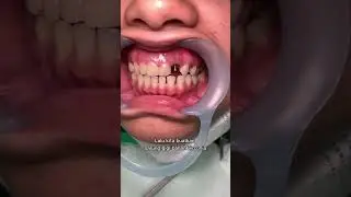 Pemasangan Sarung Gigi Maryland