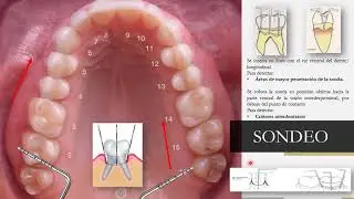 Sondeo periodontal, 1era Parte