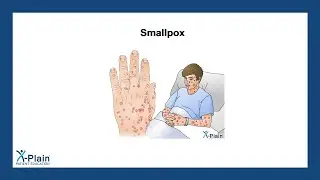 Smallpox