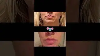 Perfect PRF Lip Transformation: Natural Volume & Definition