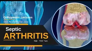 Septic Arthritis: Diagnosis, Treatment & Surgery | Ortho Basics #Ortho #Arthritis #mbbs # usmle