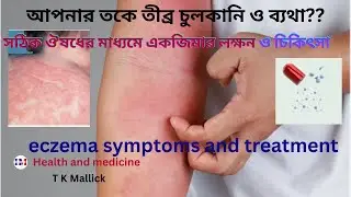 সঠিক ঔষধের মাধ্যমে  একজিমার লক্ষণ ও চিকিৎসা ।।Eczema: Symptoms & Effective Treatment