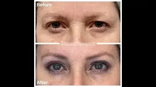 Before and After Endoscopic Brow Lift and Blepharoplasty Surgery.