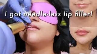 getting lip filler for the FIRST time *needleless + painless*