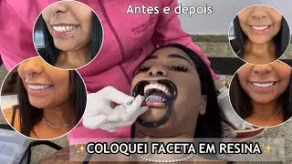 COLOQUEI FACETAS EM RESINA| Sorriso novo| Valores| cuidados| Doeu?| Contei tudo✨