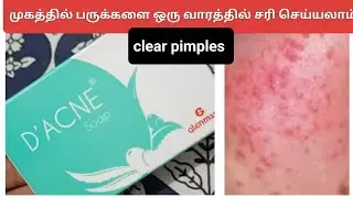 d acne soap review in tamil #pimplesremoval #acneproneskin