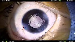Restoring Vision Early: Live Pediatric Cataract Surgery with Nanex IOLPerformed by Dr. Gaurav Luthra