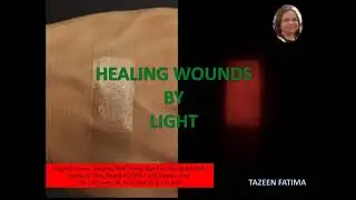 Healing wounds by light - Video by Tazeen fatima