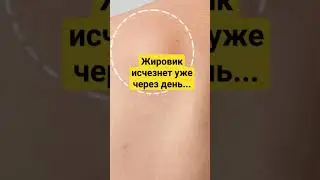 Жировик лечение в домашних условиях #здоровье #медицина #жировик